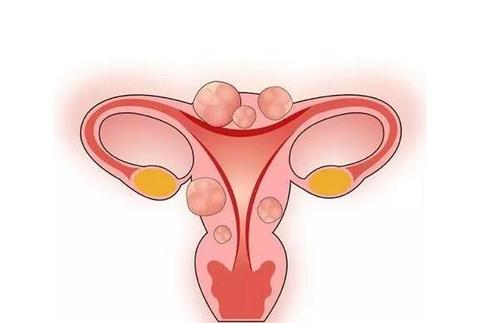 3类女性最易患上子宫肌瘤 如何远离子宫肌瘤