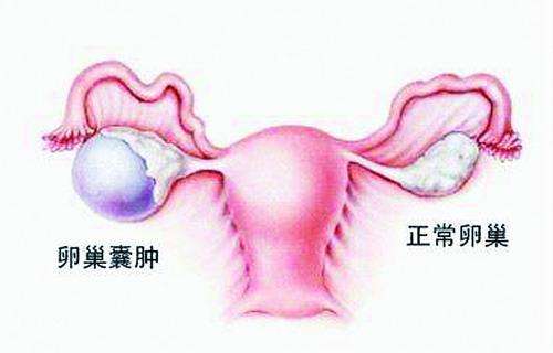 卵巢囊肿三大体征 囊肿护理事项有哪几种
